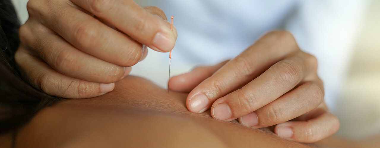 Dry Needling Therapy